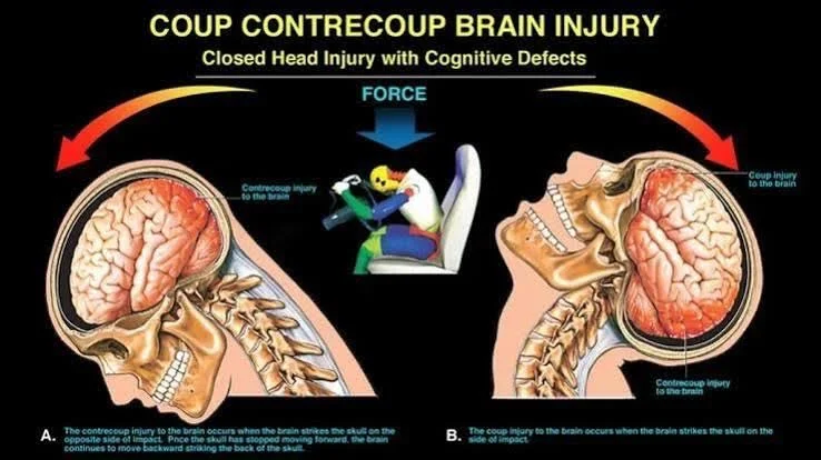 Coup-contrecoup brain injury diagram